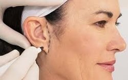 Otoplastia (plastica urechilor, eliminarea urechilor accidentale)