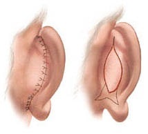 Otoplastia (plastica urechilor, eliminarea urechilor accidentale)