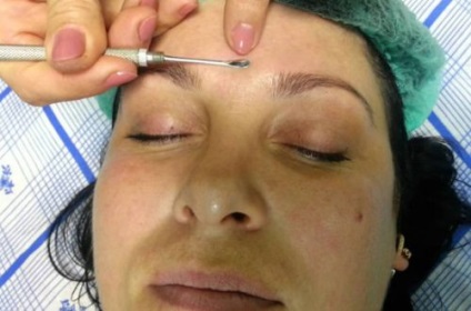 Cauzele și metodele de eliminare a miliumului pe față