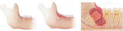 Probleme cu dintele de înțelepciune; de ce dinții de înțelepciune cresc incorect; consultarea unui dentist