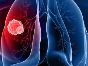 Prognoza pentru cancerul pulmonar - tratamentul cancerului pulmonar și prevenirea acestuia