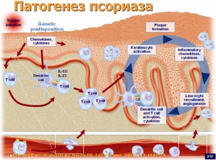 Psoriazisul de la teorie la practică