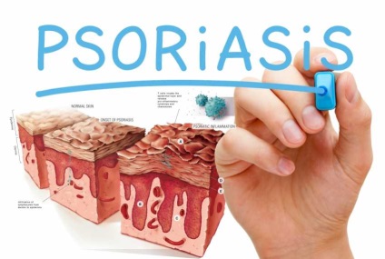 Psoriazisul de la teorie la practică