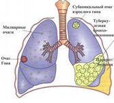 Cinci mituri despre tuberculoză