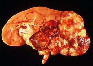 Renovările cancerului de rinichi după eliminare, etapa 1, alcoolul și tumorile