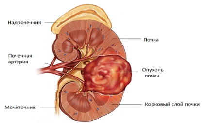 Simptome și semne de cancer renal, clasificare, tratament