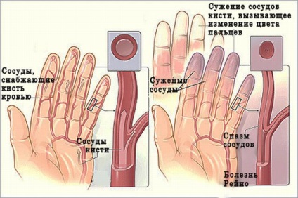 Sindromul (boala) Reynaud - cauze, clasificare, tratament