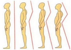 Scolioza 1 și 2 grade, simptom și tratament al scoliozelor, exerciții