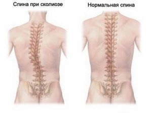 Scolioza 1 și 2 grade, simptom și tratament al scoliozelor, exerciții