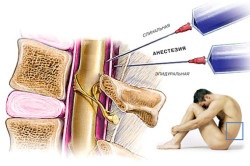 Efectele anesteziei spinării și complicațiile