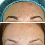 Curățarea cu ultrasunete a feței, blogul femeilor - un site despre sănătate și frumusețe