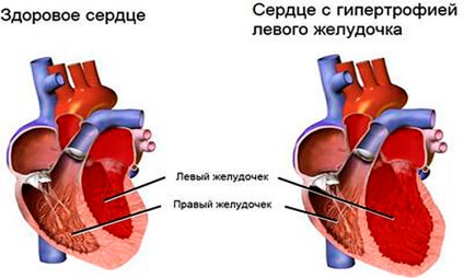 Creșterea cauzei inimii ventriculare stângi și tratamentul, consecințe