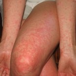 Allergia (allergiás) allergia