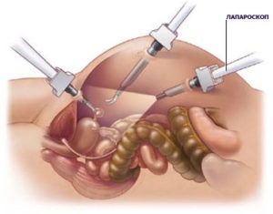 Constipație după intervenție chirurgicală, cauze și metode de tratament, prevenire