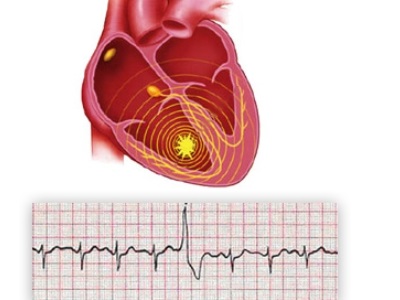 Extrasistolul ventricular cauzează, simptomele și clasificarea extrasistolelor ventriculare de gazon