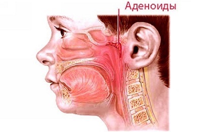 Adenoizii la copii (la un copil), simptome, semne și cum să recunoască