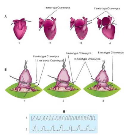Analiza excitației inimii