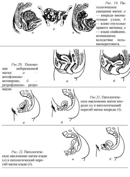 Anomalii ale poziției organelor genitale feminine