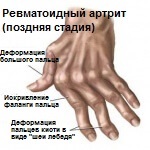 Artrita degetelor mâinilor 7 remedii naturale care îi vor calma simptomele - un pas spre sănătate