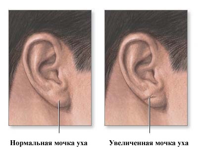 Ateromul fotografiei urechilor (în spatele urechii), tratament, operație