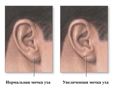 Атером ухото лоб (зад ухото) изображение, лечение, хирургия