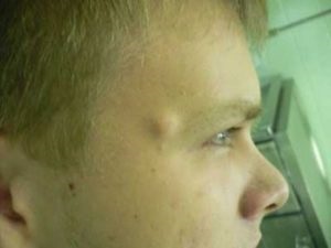 Ateromul pe fața chistului sub piele a tratamentului cu auricul, îndepărtarea cu laser