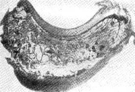 Kinbeck necroză aseptică a osului semilunar