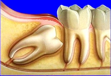 Dintele de înțelepciune suferă ce trebuie să facă sau să facă