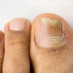 Ciuperca de unghii de pe picioare este periculoasă pentru viața umană
