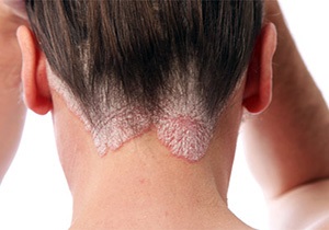 Scaly lichen corect de îngrijire a pielii va accelera procesul de vindecare
