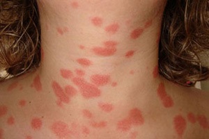 Psoriasis megfelelő bőrápoló felgyorsítja a gyógyulási folyamatot