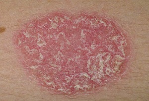 Psoriasis megfelelő bőrápoló felgyorsítja a gyógyulási folyamatot