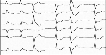 Stimularea electrică transesofagiană în diagnosticul ibs