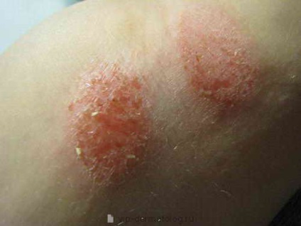 Ce este eczema - boala de piele