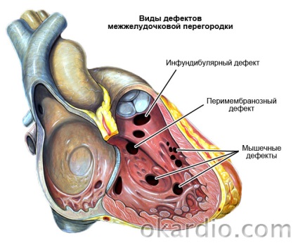 Kamrai septum defectus (VSD) okoz besorolás kezelés