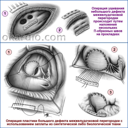 Kamrai septum defectus (VSD) okoz besorolás kezelés