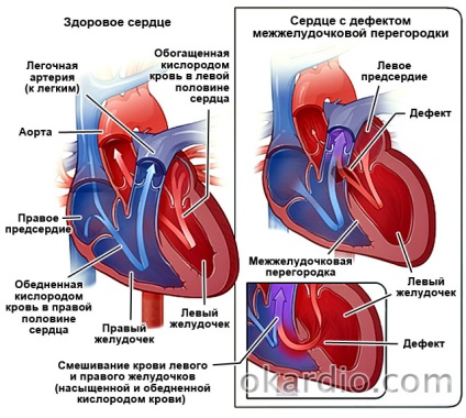 Defectul septului interventricular (dmjp) cauzează, clasificarea, tratamentul