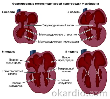 Kamrai septum defectus (VSD) okoz besorolás kezelés