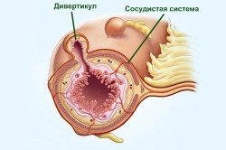 Diéta diverticulosis a szigmabélen