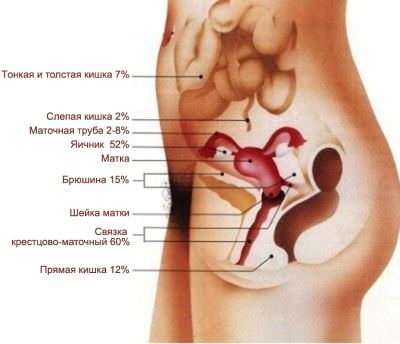 Endometrioza cauzează, simptome, ceea ce este periculos