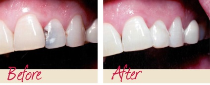 Restaurare artistică estetică a tipurilor de dinți, preț, fotografie înainte și după