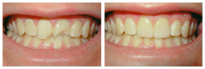 Restaurare artistică estetică a tipurilor de dinți, preț, fotografie înainte și după