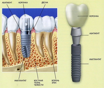 Etape de implantare a dinților