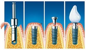 Etape de implantare a dinților