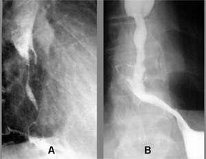 Terapia fotodinamică a bolilor oncologice; terapia fotodinamică a carcinomului bazocelular și a cancerului