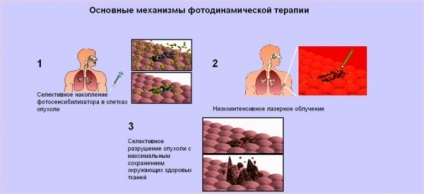 Terapia fotodinamică a bolilor oncologice; terapia fotodinamică a carcinomului bazocelular și a cancerului