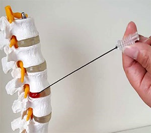În cazul în care hernia spinării este tratată fără intervenție chirurgicală