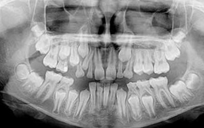 În cazul în care pentru a face o imagine panoramică digitală și 3D-X-ray de dinți