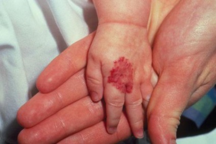 Hemangiomul la nivelul piciorului sau al mâinilor la adulți și la copii tratați