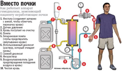 Hemodializa este tot ce trebuie sa stiti - Centrul International - donare Dializa Transplant